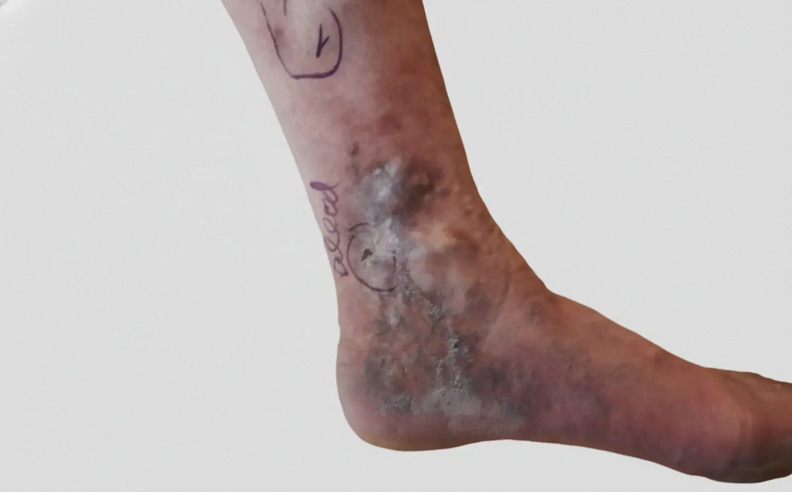 Úlcera venosa en pierna - tratamiento y prevención